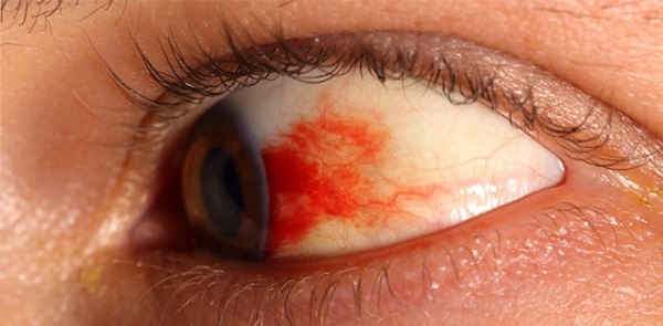 Кровоизлияния при ретинопатии