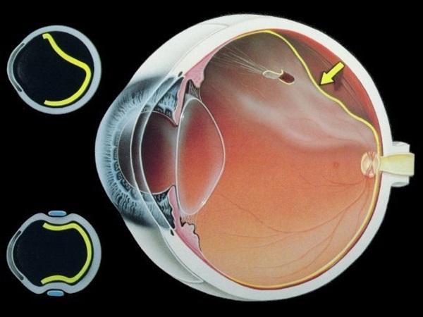 Отслоение сетчатки на фоне ретинопатии
